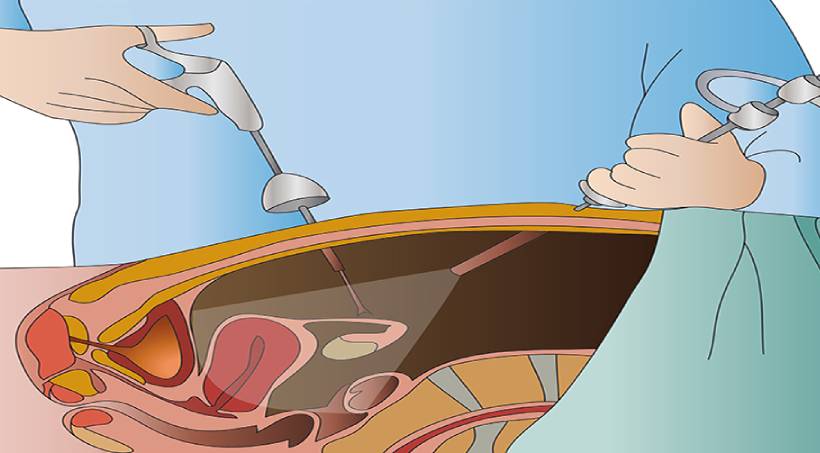 Laparoscopic Surgeries in Pune