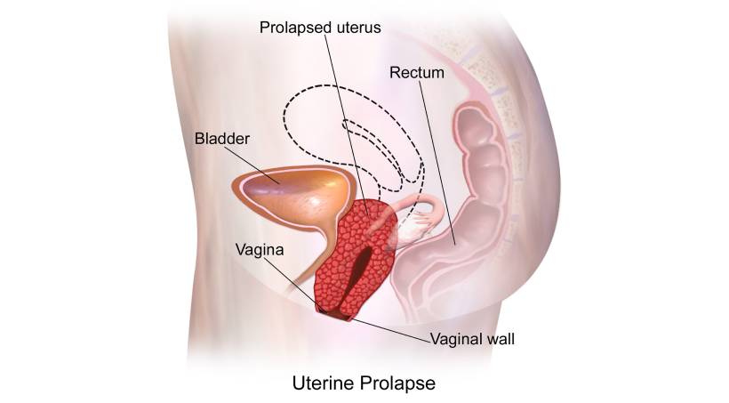 Urogynecology Services in pune